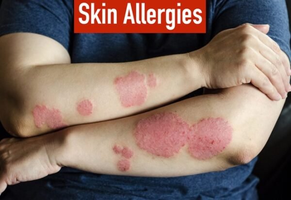 SKIN ALLERGIES RESULT